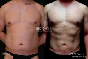 Body sculpting in korea 