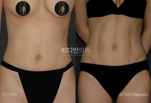 Body sculpting in korea 