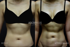 Body sculpting in korea 