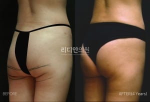 Body sculpting in korea 
