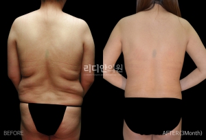 Body sculpting in korea 