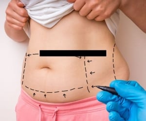 Best Liposuction Clinics in Seoul