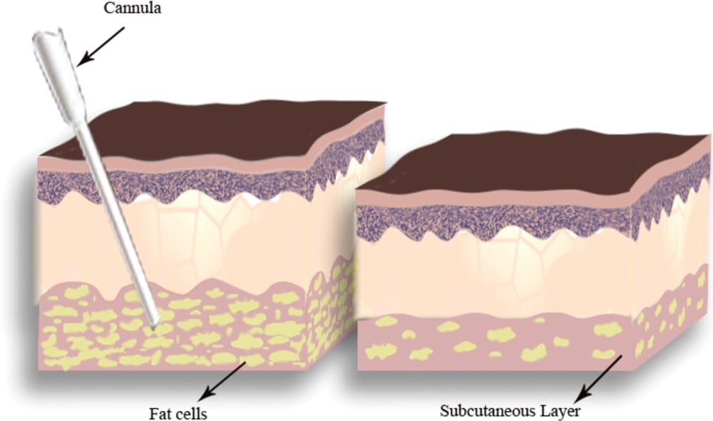 Body Sculpting in Korea  Liposcultping Types, Best Clinics, Before After  Pictures and Costs of Sculpting in Korea