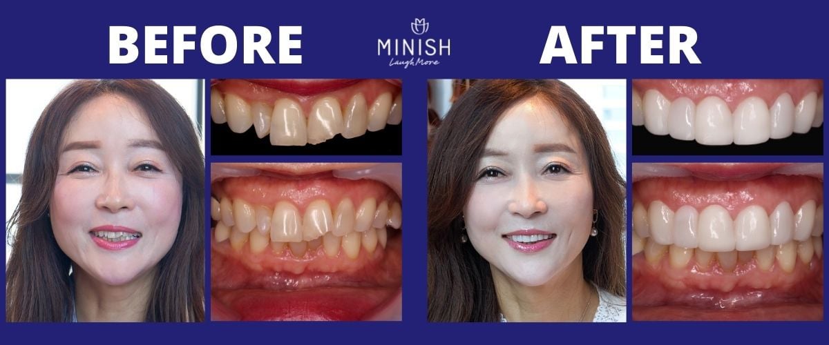 Best English Dentist Clinics Seoul, Korea Before and After Pictures