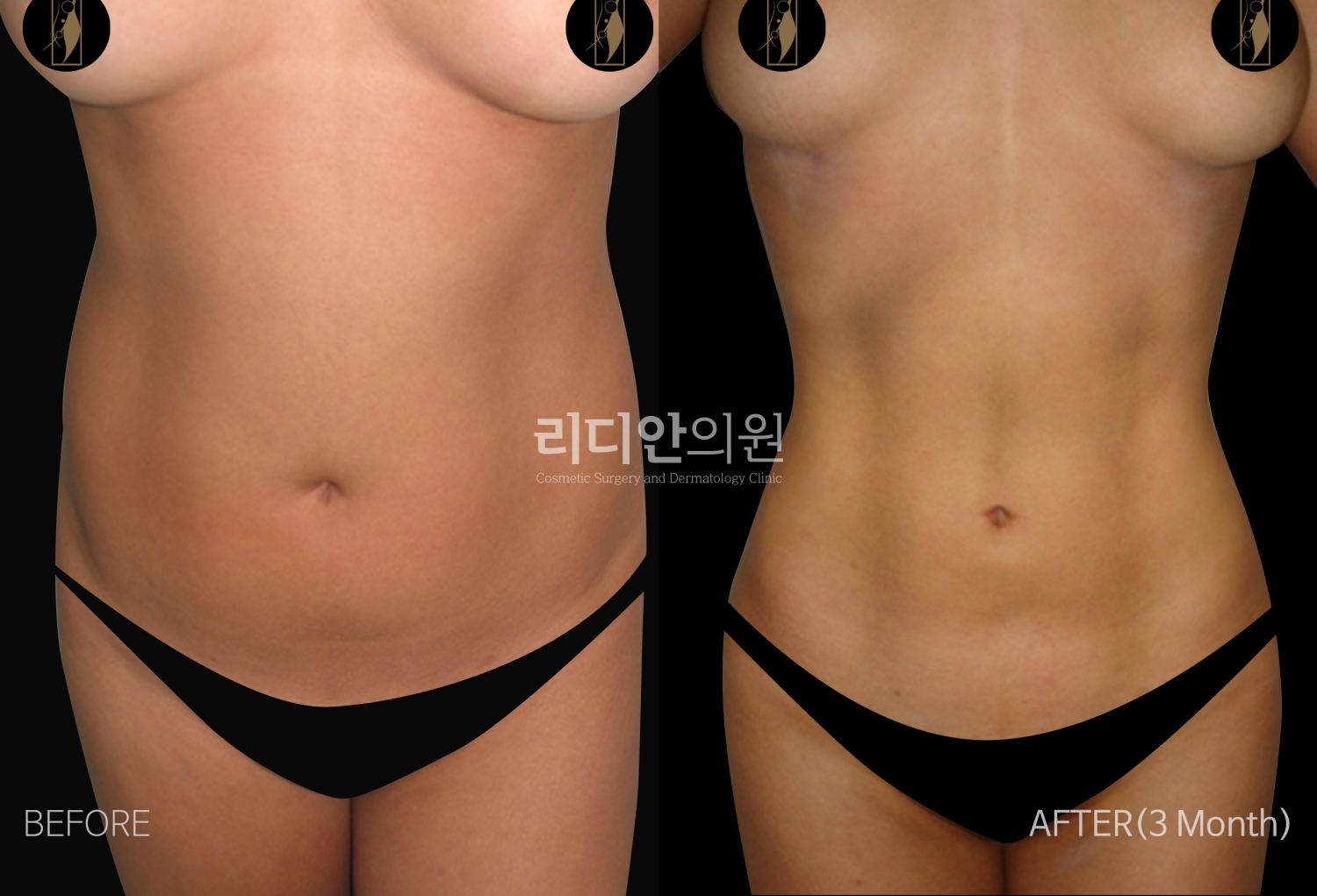 premium liposuction clinic in seoul