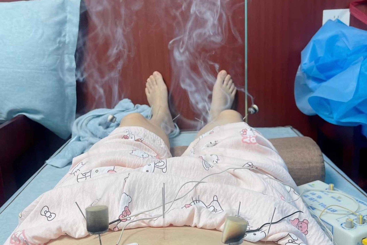 Shanghai: Kinesisk medisin, akupunktur og cupping-behandling