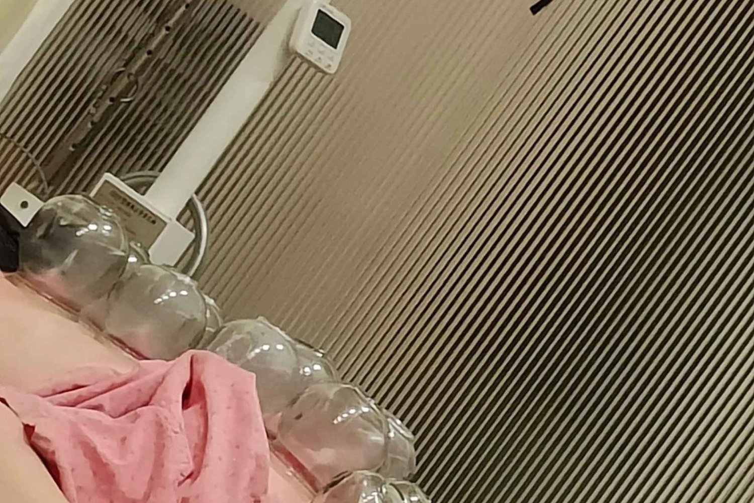 Shanghai: Kinesisk medisin, akupunktur og cupping-behandling