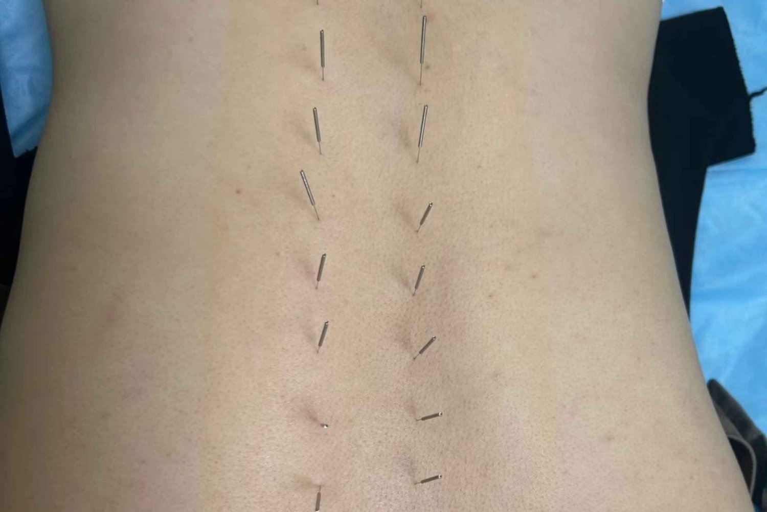 Shanghai: Kinesisk medisin, akupunktur og cupping-behandling