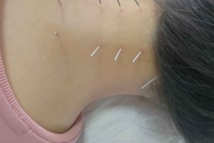 Shanghai: Kinesisk medisin, akupunktur og cupping-behandling