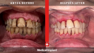 Medical Implant