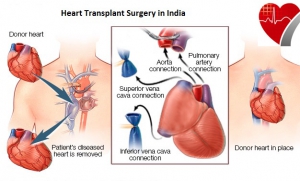 Best Heart Transplant Surgery at Affordable Cost in India